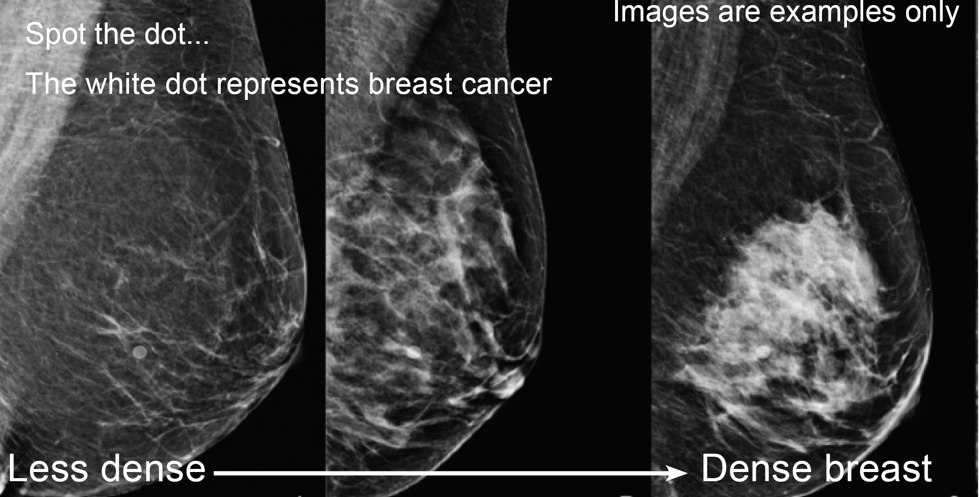 BreastScreen WA   DEC 2020 Updated Breast Density Image 