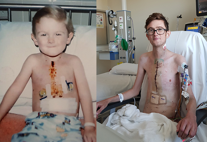 Two photos side by side. The left photos is a smiling toddler sitting in a hospital bed with a scar running down his breastbone. The second photo shows a young man sitting in hospital bed, again with a scar running down his breastbone.