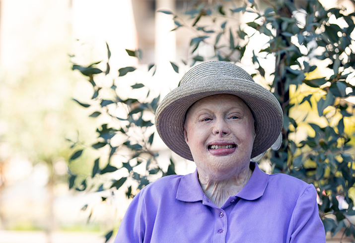 A woman with burn scars in her face sits in a garden setting
