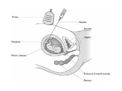 Figure 2: Chorionic villus sampling