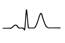 ECG - Potassium greater than 6mmol