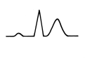 ECG - potassium greater than 7.5mmol